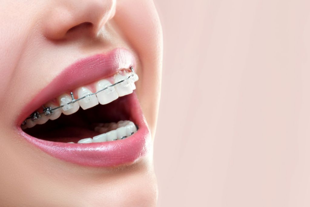 Brackets Estéticos en Beniel | De la Torre Clínica Dental