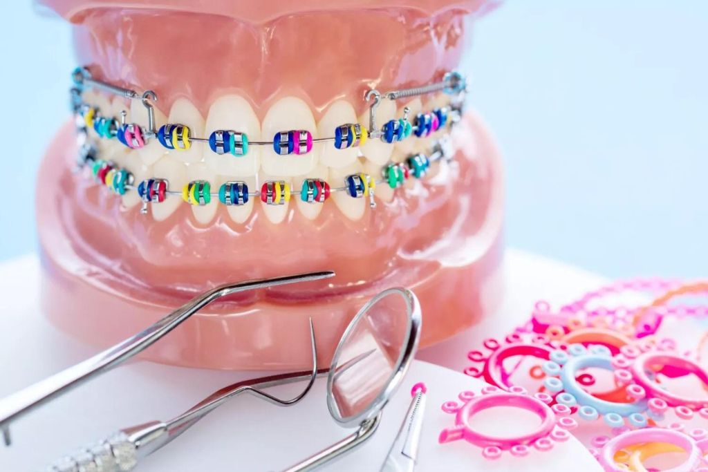 Brackets Metálicos en Beniel | De la Torre Clínica Dental