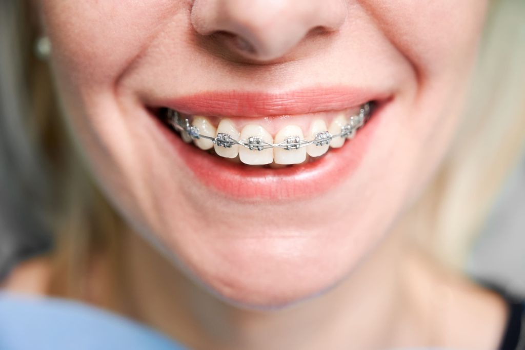 Brackets Metálicos en Beniel | De la Torre Clínica Dental