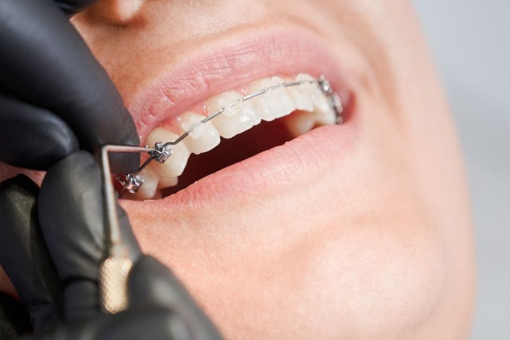 Brackets de Porcelana en Beniel | Clínica Dental De la Torre