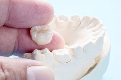 Coronas Dentales en Beniel | De la Torre Clínica Dental