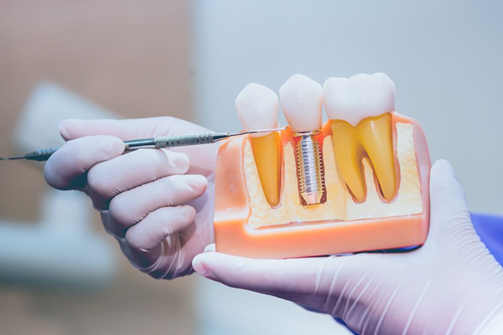 Implantes Dentales en Beniel | De la Torre Clínica Dental