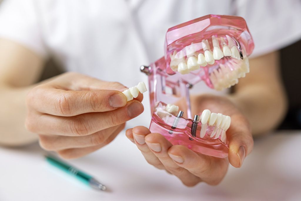 Implantes Dentales en Beniel | De la Torre Clínica Dental