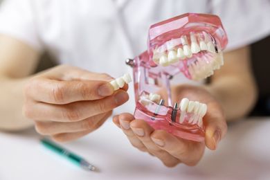 Implantes Dentales en Beniel | De la Torre Clínica Dental