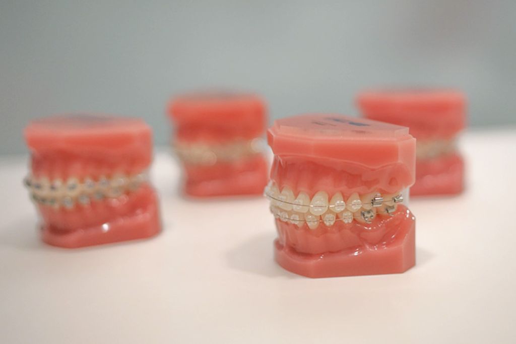 Ortodoncia Estética en Beniel | De la Torre Clínica Dental